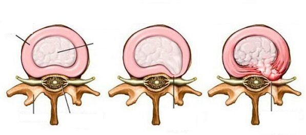 hernie intervertébrale avec ostéochondose cervicale