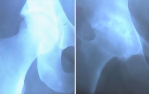 Haine de l'arthrose de l'articulation du genou