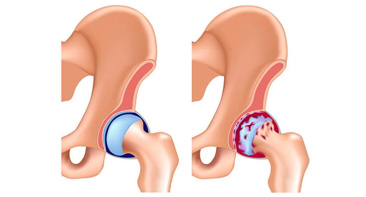 articulation de la hanche saine et affectée par l'arthrose