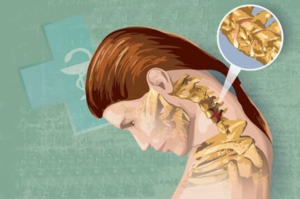 Symptômes réflexes de l'ostéochondose